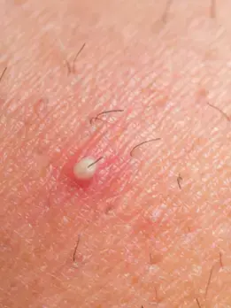 Reduces ingrown hair img2